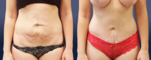 Abdominoplasty Patient 04