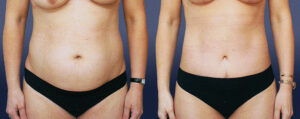 Abdominoplasty Patient 06