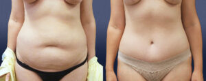 Abdominoplasty Patient 07