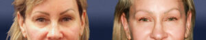Blepharoplasty Patient 02