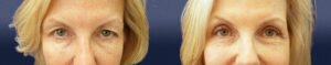 Blepharoplasty Patient 03