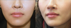 Mole Removal Patient 01