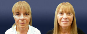 Neck Lift Patient 03