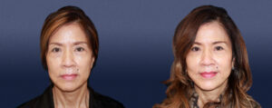 Facelift Patient 04