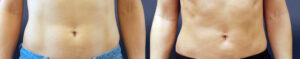 Liposuction Gallery