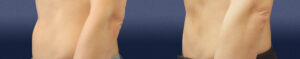 Liposuction Gallery