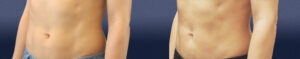 Liposuction Gallery