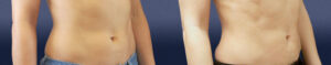 Liposuction Gallerty