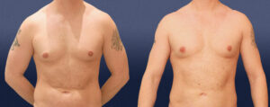 Liposuction Patient 04
