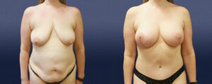 Mommy Makeover Patient 01