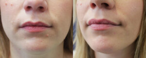 Mole Removal Patient 04