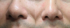Mole Removal Patient 05