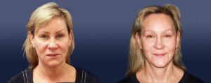 Neck Lift Gallery