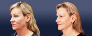Neck Lift Gallery