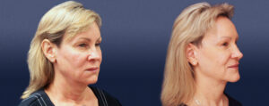 Neck Lift Gallery