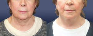 Neck Lift Patient 04