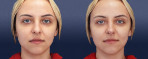 Liquid Rhinoplasty Gallery