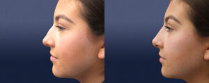 Liquid Rhinoplasty Patient 05